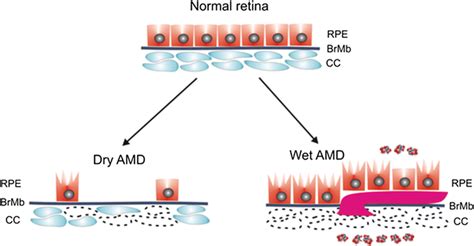 wet amd|wet amd vs dry amd.
